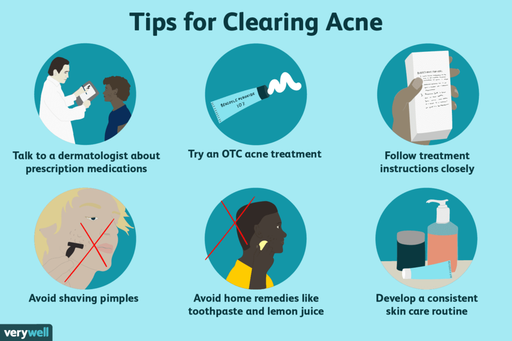 10 Effective Ways to Treat Acne