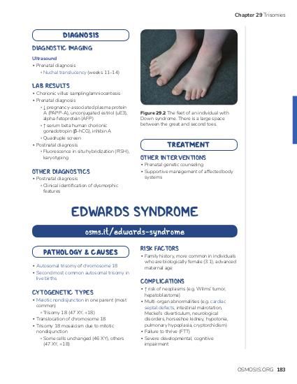 A Comprehensive Overview of Edwards Syndrome: Risks and Complications A Comprehensive Overview of Edwards Syndrome: Risks and Complications