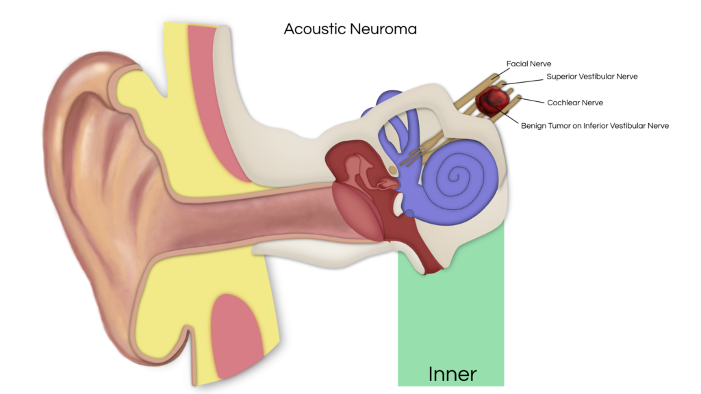 Acoustic Neuroma: Common Misconceptions Debunked