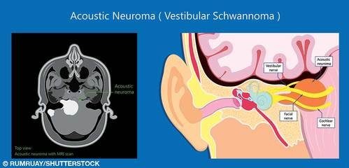 Acoustic Neuroma: Common Misconceptions Debunked