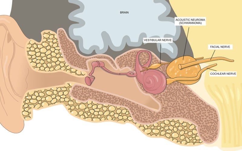 Acoustic Neuroma: Common Misconceptions Debunked