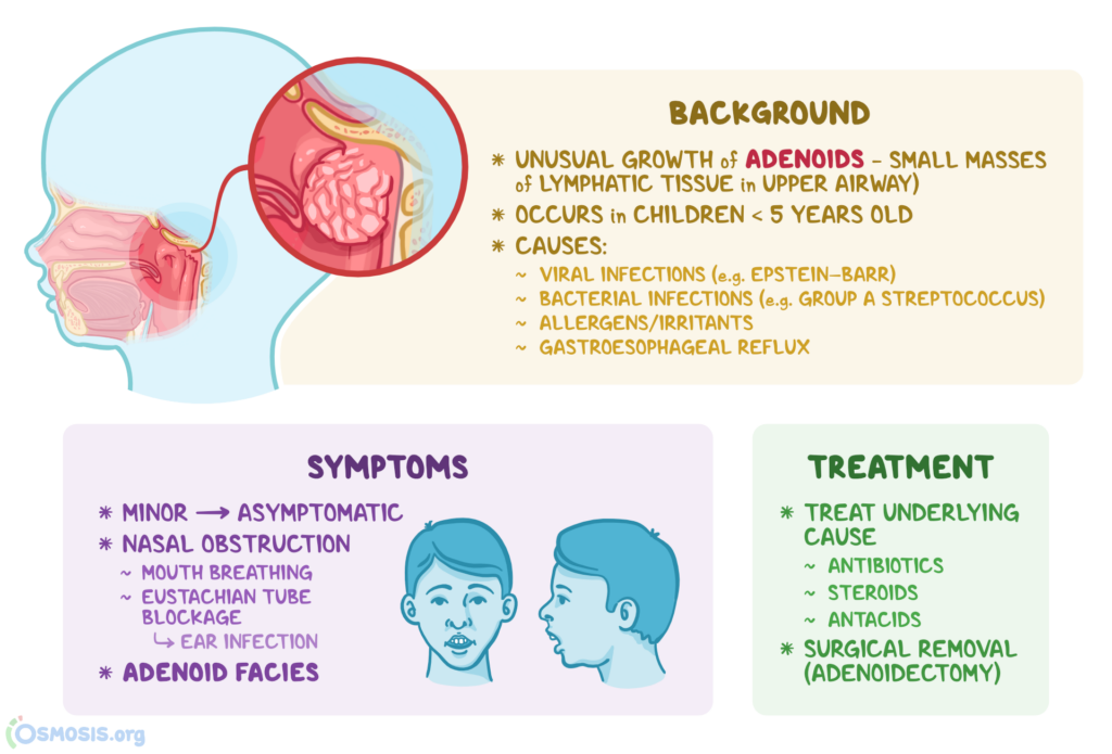 Adenoiditis: Causes and Complications Adenoiditis: Causes and Complications