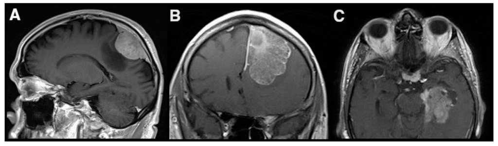 Advancements in Meningioma Research