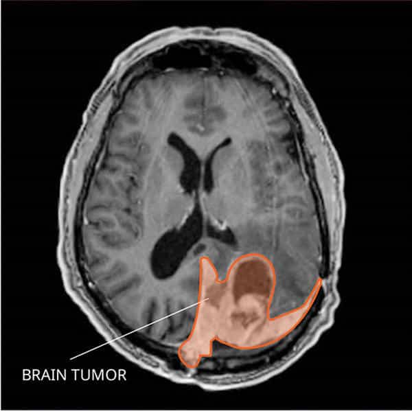 Advancements in Meningioma Research