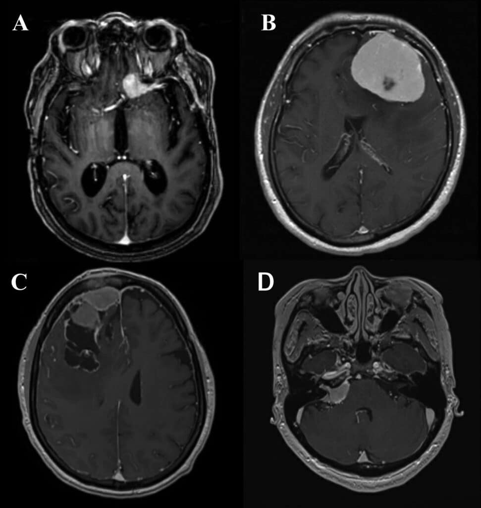 Advancements in Meningioma Research