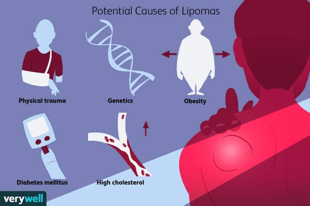 An In-Depth Look at Lipoma: Symptoms and Treatment