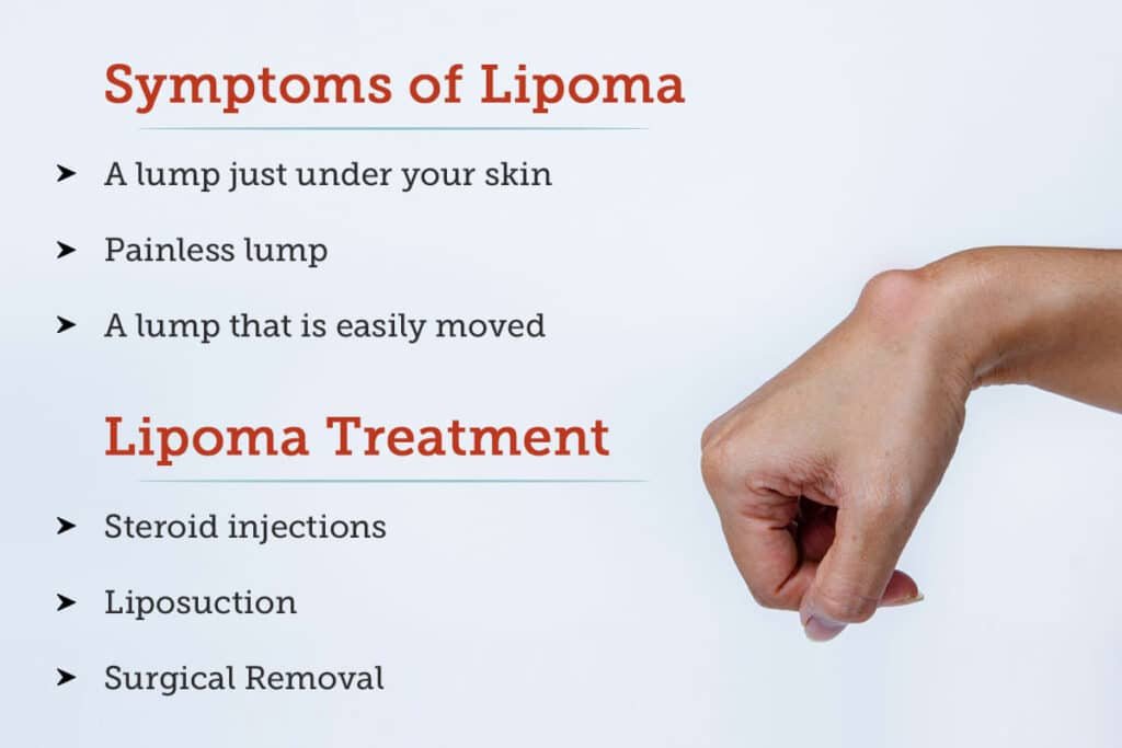 An In-Depth Look at Lipoma: Symptoms and Treatment