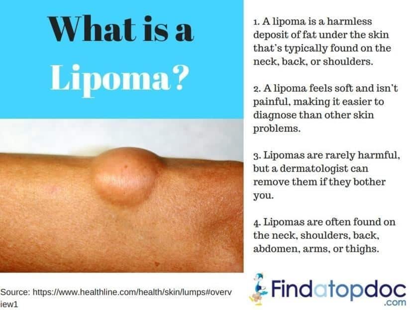 An In-Depth Look at Lipoma: Symptoms and Treatment