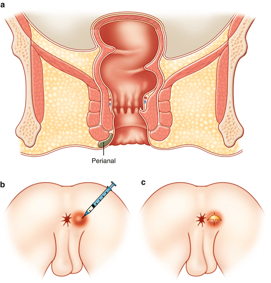 Anal Abscess Drainage: Procedure and Recovery