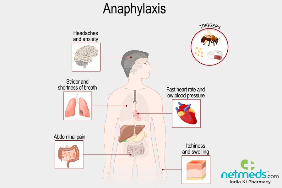Anaphylaxis Triggers: Know Your Risks
