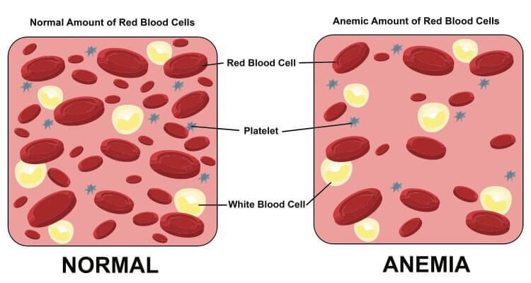Anemia in Pregnancy: Effects and Solutions