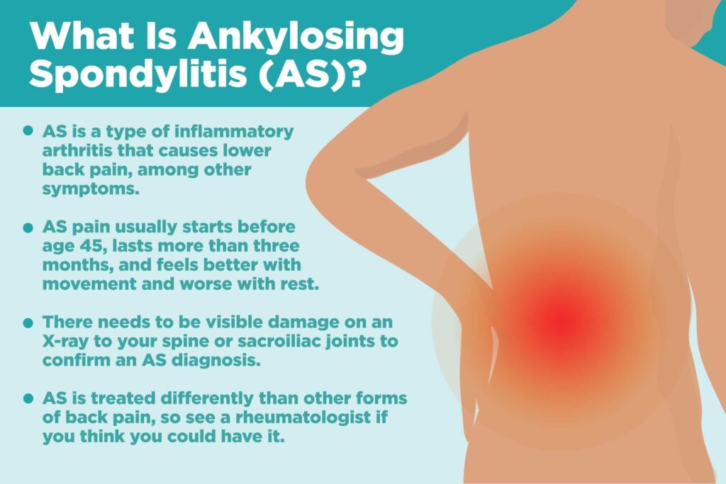 Ankylosing Spondylitis: Diagnosis and Early Intervention