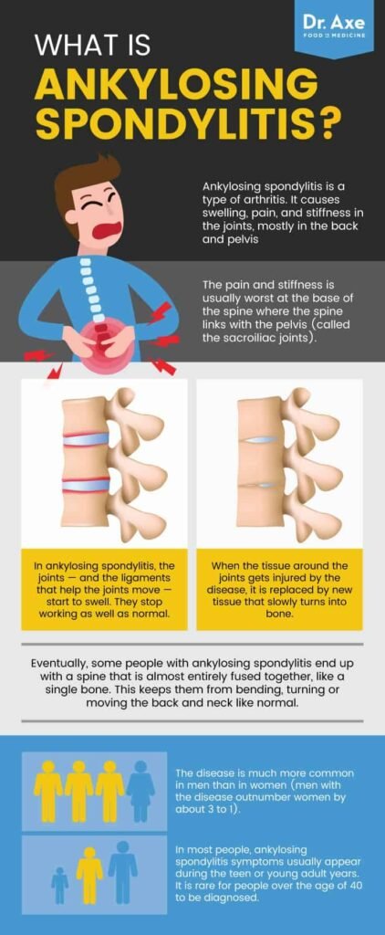 Ankylosing Spondylitis: Diagnosis and Early Intervention