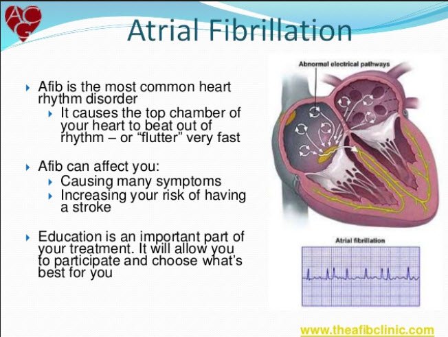 Atrial Fibrillation and Its Impact on Heart Health