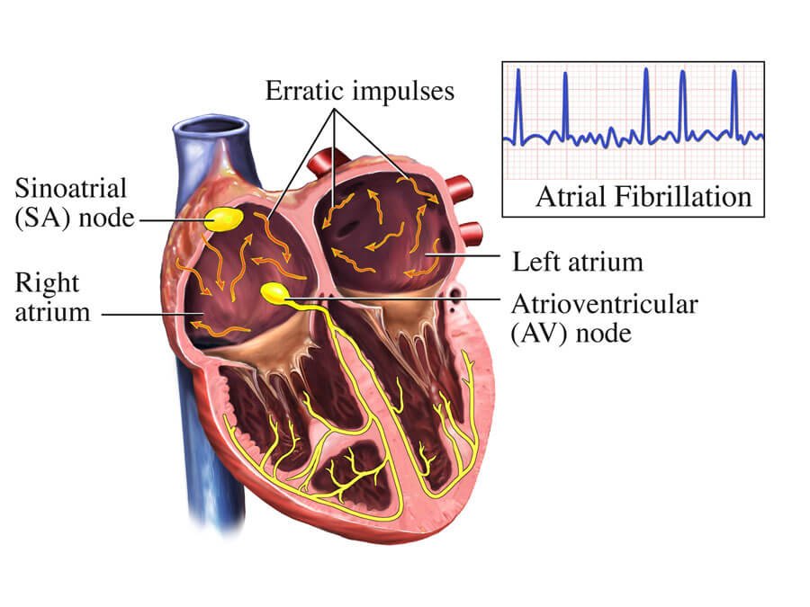 Atrial Fibrillation and Its Impact on Heart Health
