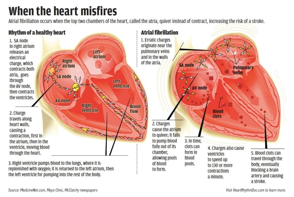 Atrial Fibrillation and Its Impact on Heart Health