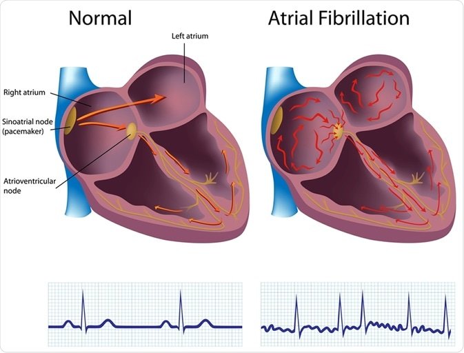 Atrial Fibrillation and Its Impact on Heart Health