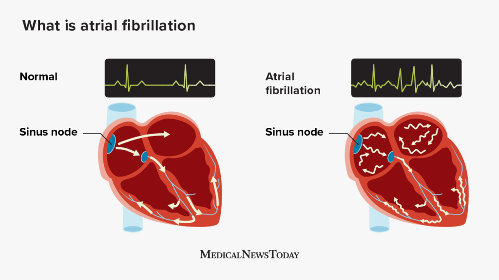 Atrial Fibrillation and Its Impact on Heart Health