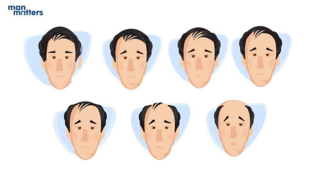 Balding: Understanding the Stages of Hair Loss