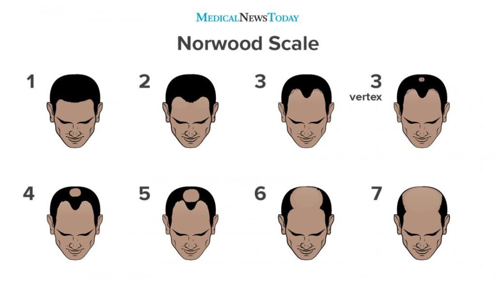 Balding: Understanding the Stages of Hair Loss