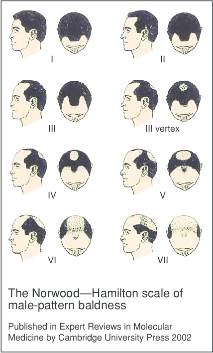 Balding: Understanding the Stages of Hair Loss