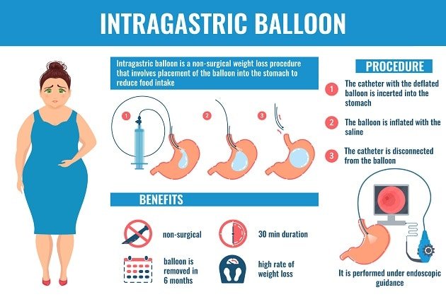 Bariatrics: A Solution for Obesity