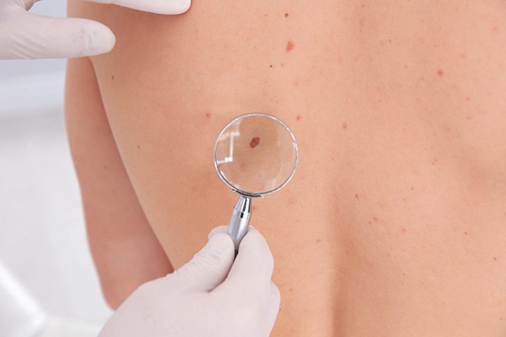 Best Practices for Nursing Considerations in Managing Precancerous Skin Lesions and Skin Cancer