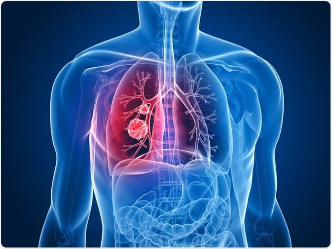 Breakthroughs in Lung Cancer Research