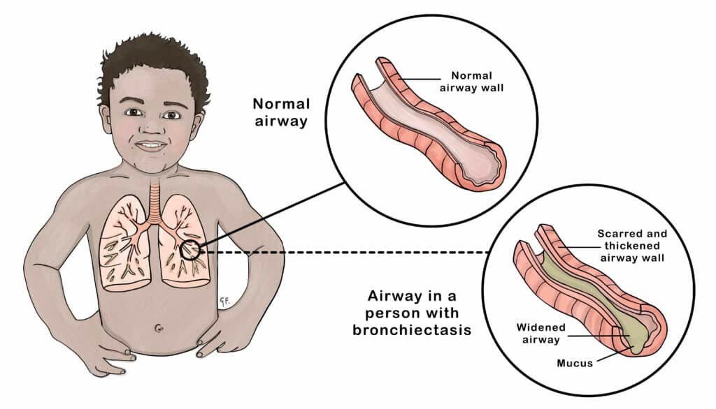 Bronchiectasis in Children: Symptoms and Treatment