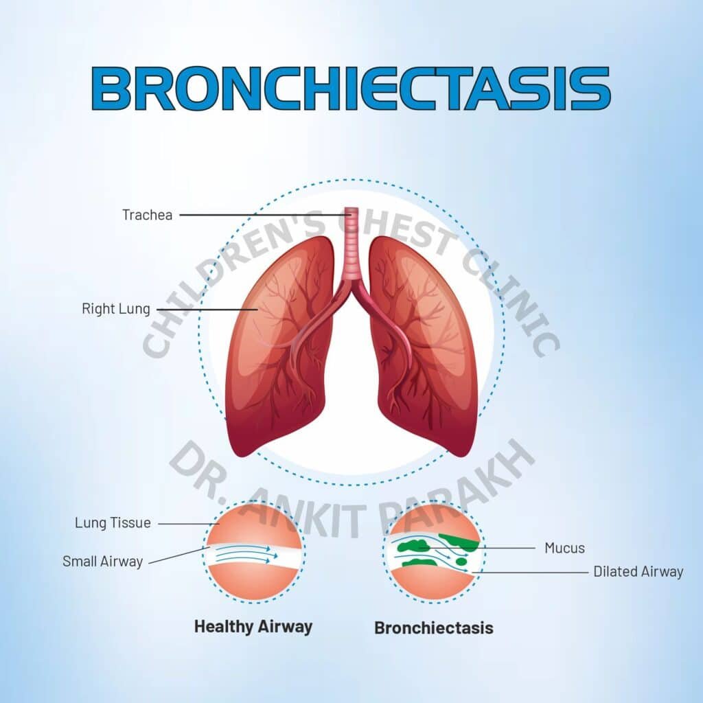 Bronchiectasis in Children: Symptoms and Treatment