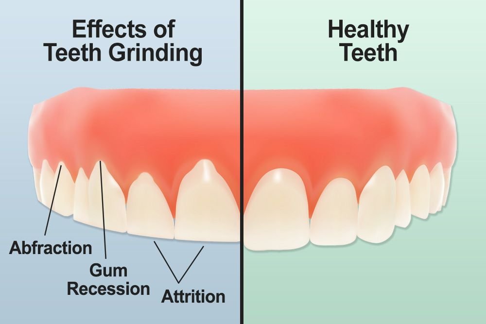 Bruxism and its Impact on Dental Health