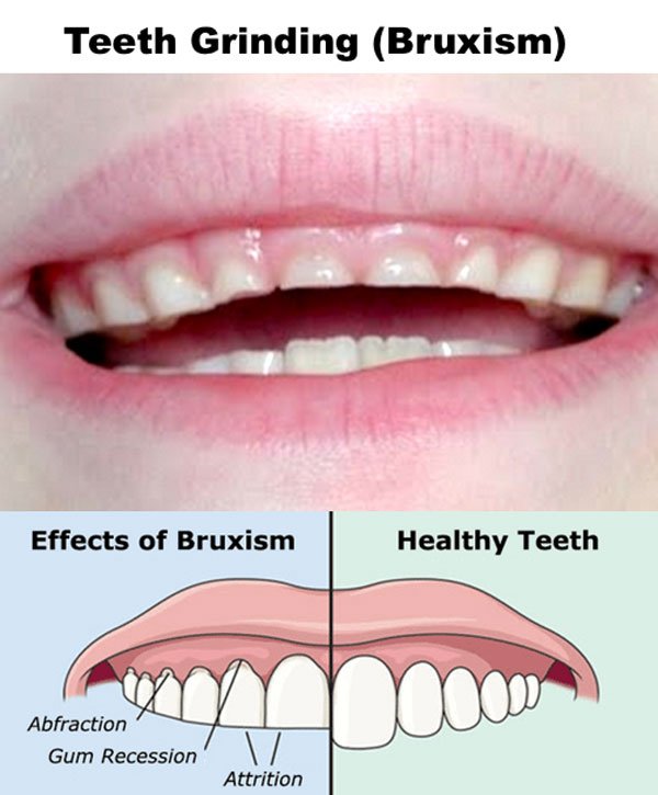 Bruxism and its Impact on Dental Health