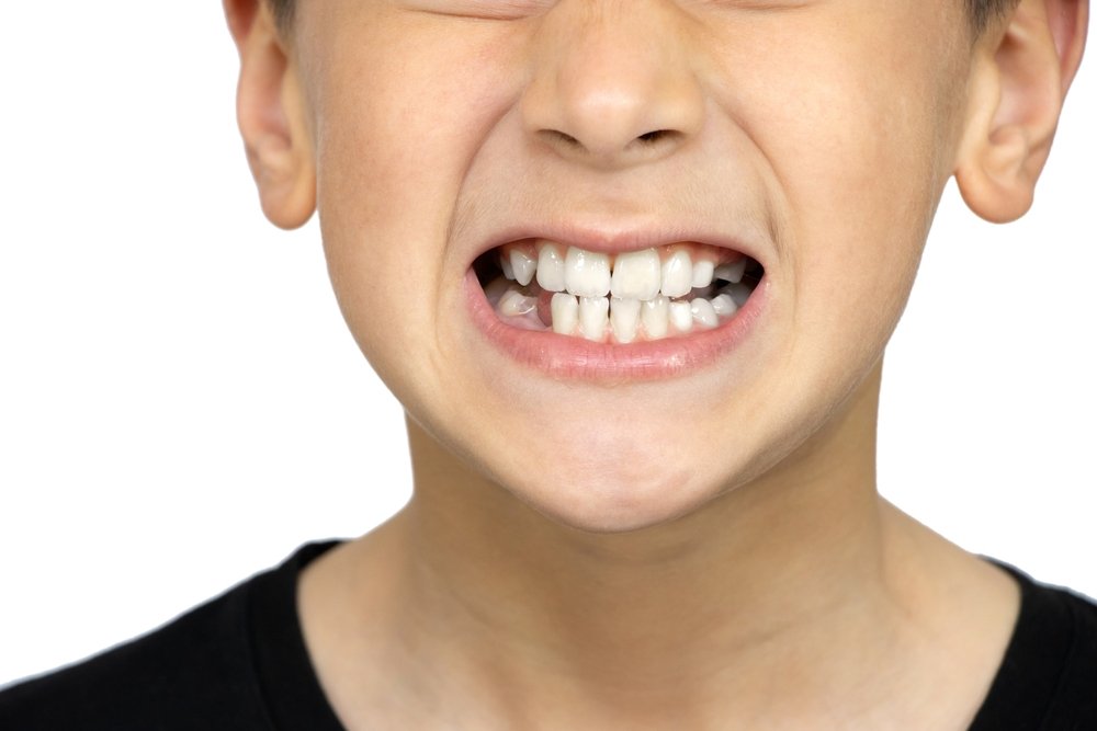 Bruxism in Children: Recognizing and Addressing the Problem