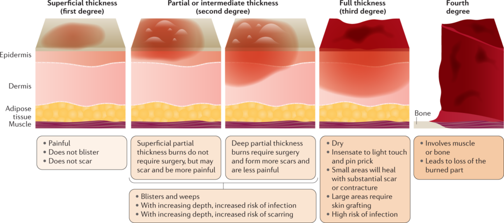 Burns: Causes, Symptoms, and Treatment Options