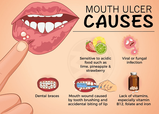 Causes and Symptoms of Mouth Ulcers