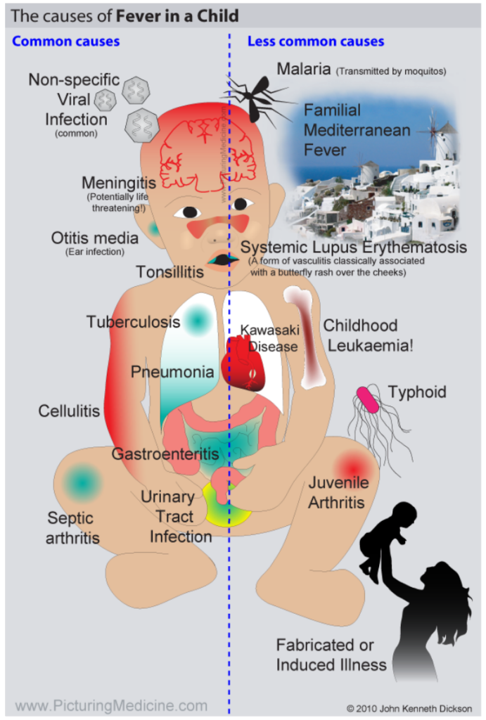 Causes of Febrile Seizures