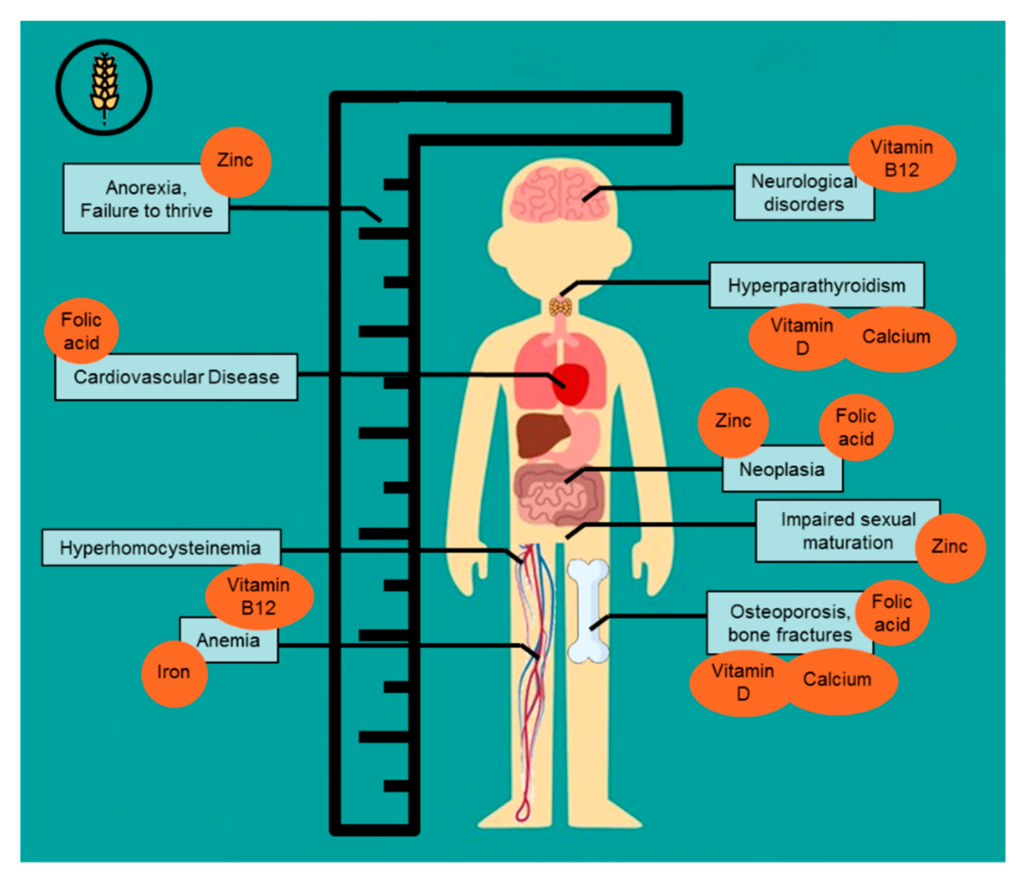 Celiac Disease and Nutritional Deficiencies