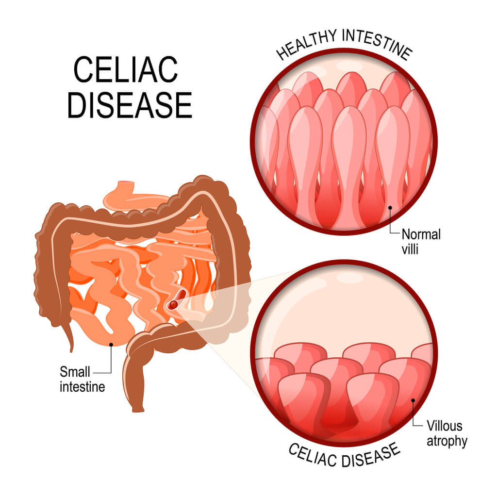 Celiac Disease in Children Celiac Disease in Children