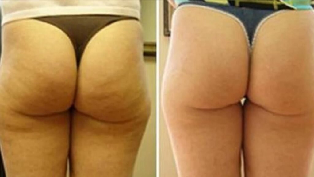 Cellulite 101: Everything You Need to Know