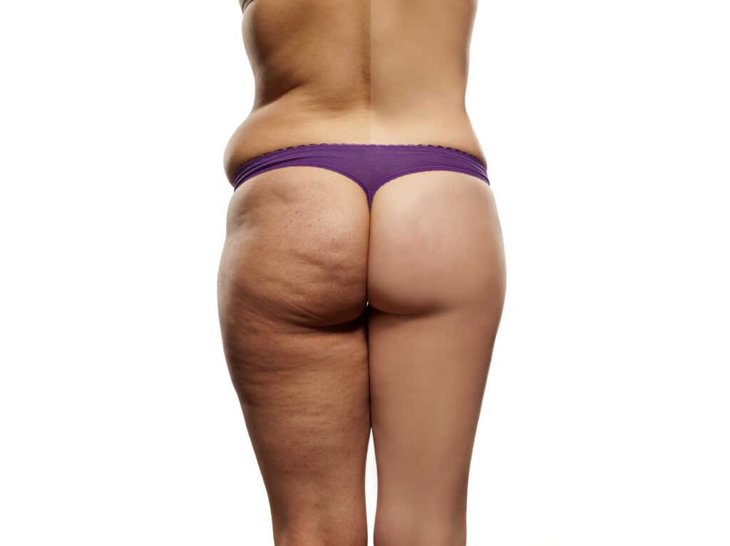Cellulite 101: Everything You Need to Know