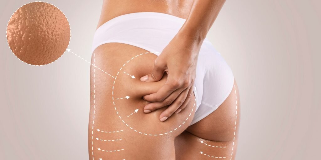 Cellulite Solutions: Tried and Tested Methods