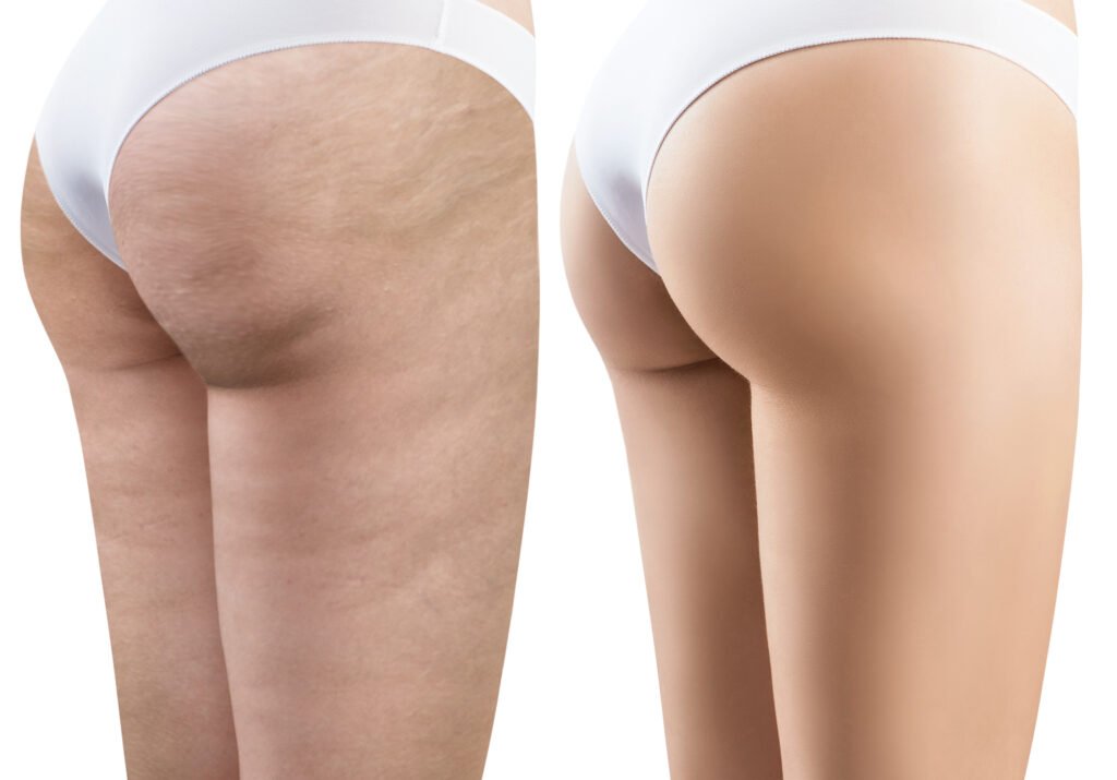 Cellulite Solutions: Tried and Tested Methods