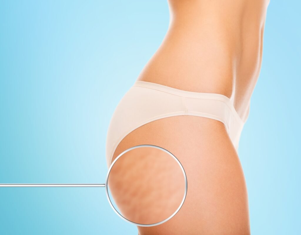 Cellulite Solutions: Tried and Tested Methods