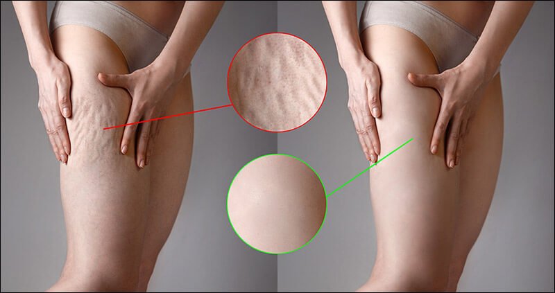 Cellulite Solutions: Tried and Tested Methods