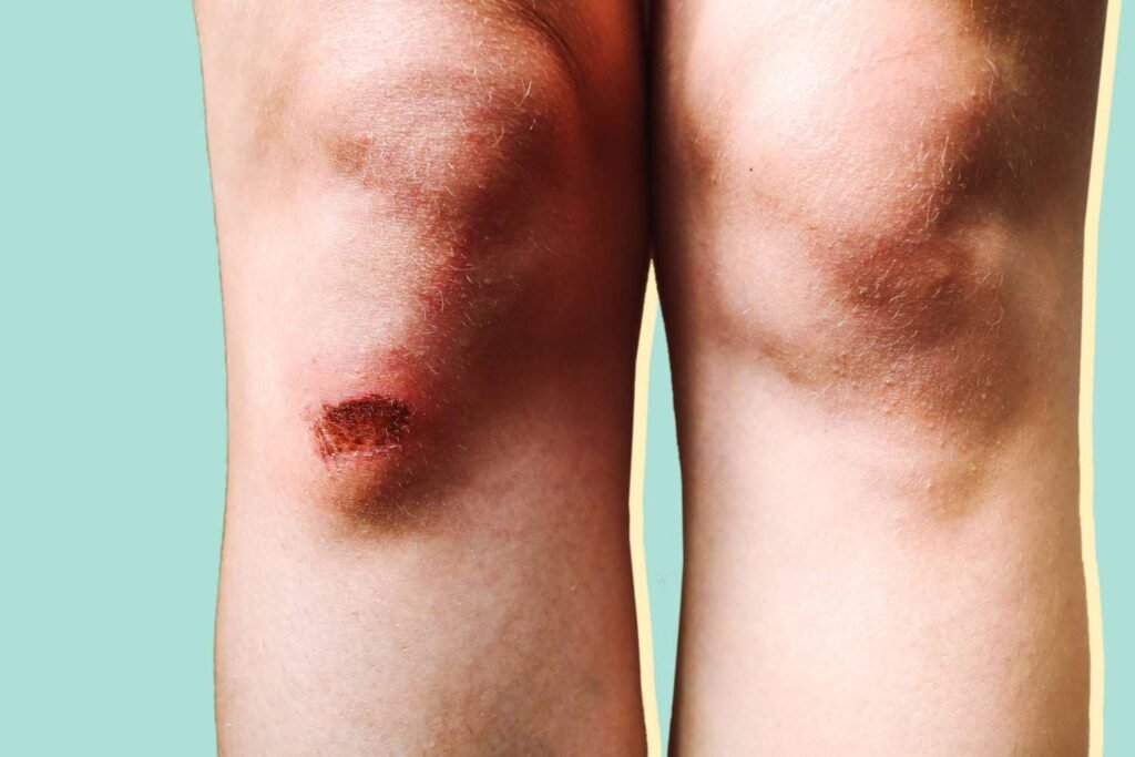 Cellulitis Complications: When to Seek Medical Attention