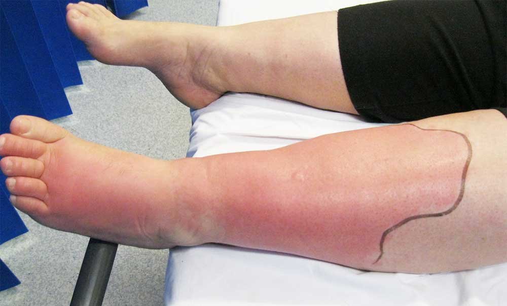 Cellulitis Complications: When to Seek Medical Attention