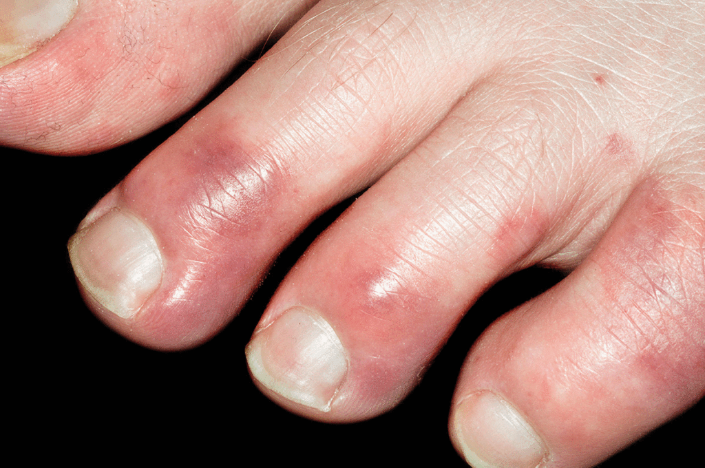 Chilblains in Children: Recognizing and Treating the Condition