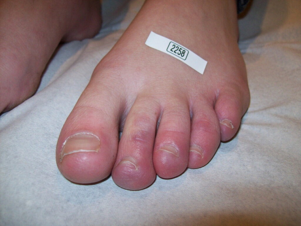 Chilblains in Children: Recognizing and Treating the Condition