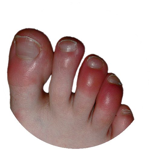 Chilblains in Children: Recognizing and Treating the Condition