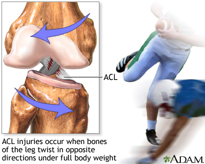 Common Causes of Anterior Cruciate Ligament (ACL) Injuries